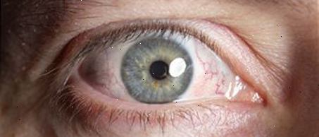 טיפולי דלקת עיניים