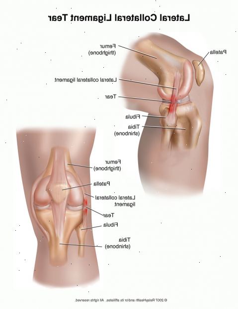 פציעות ברך - רצועות בטחונות. אילו סוגים של פציעות בברך יש?